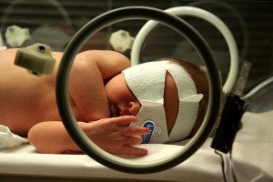 Jaundice_phototherapy-300x200.jpg